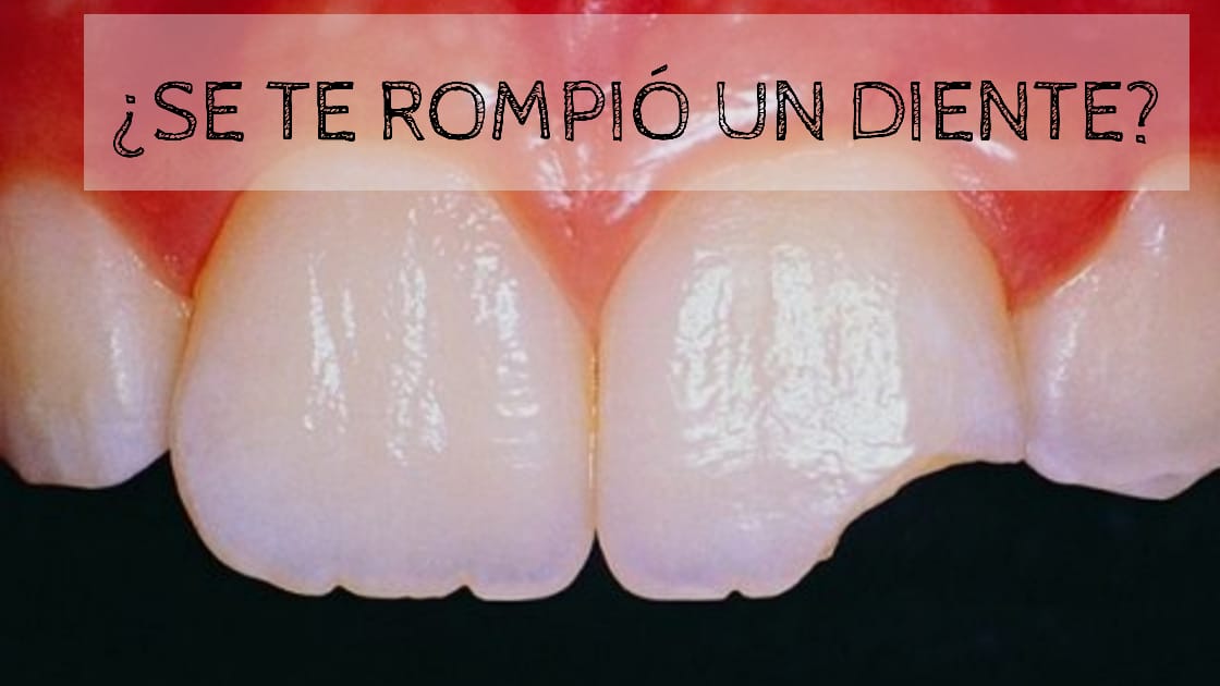 ¿Se te rompió un diente?