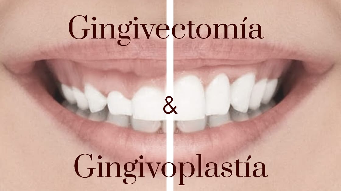 Gingivoplastía y Gingivectomía