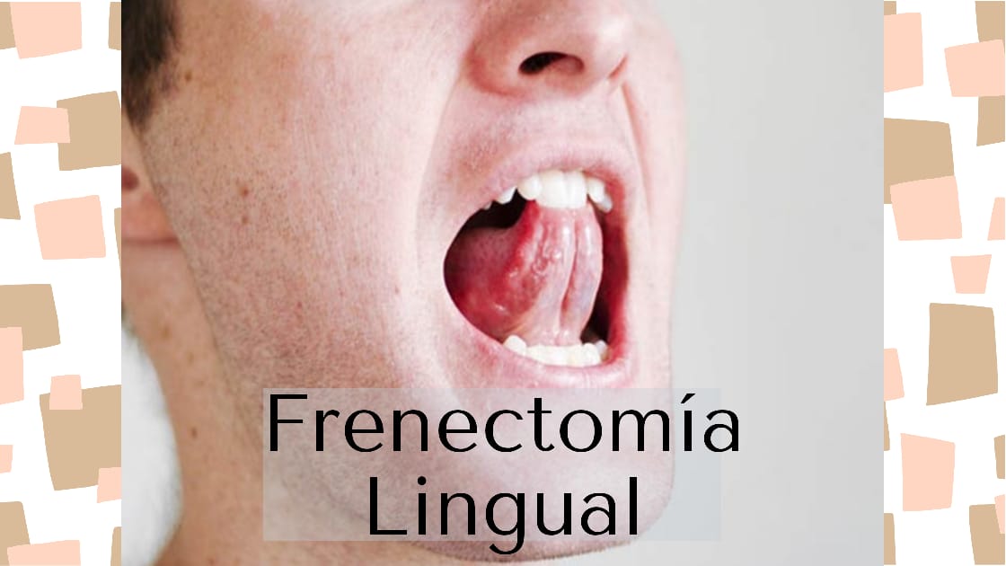 Frenectomía Lingual