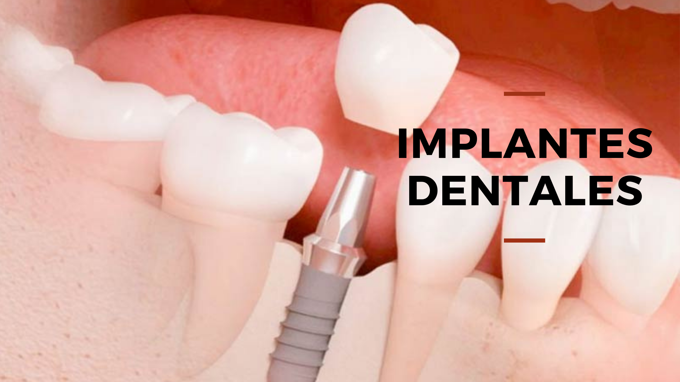 Implantes dentales