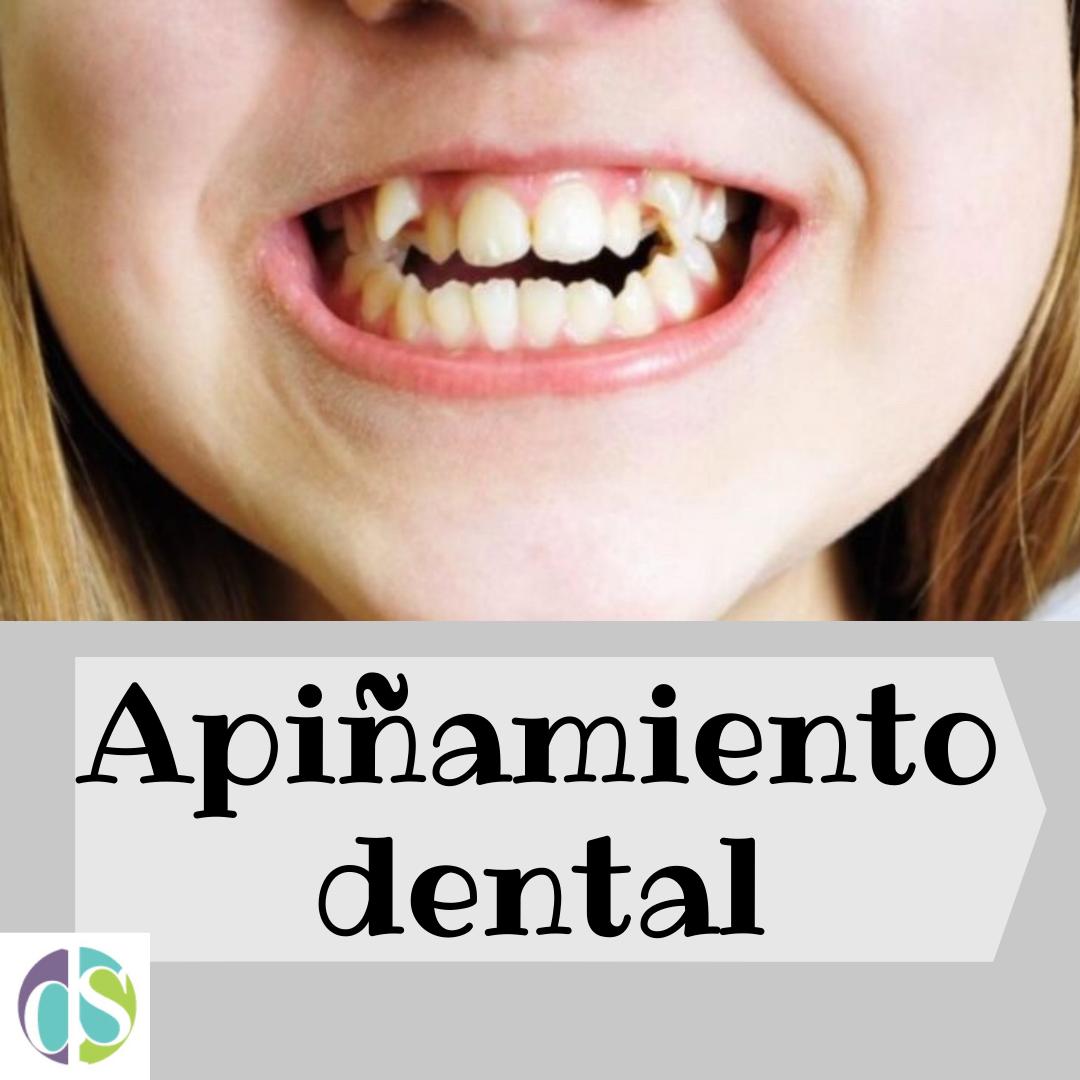 Apiñamiento Dental