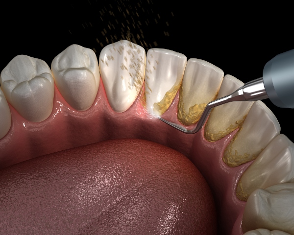 Sarro Dental Y Sus Consecuencias | Clínica Dental Smile | Clínica ...